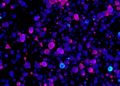 Single-Cell Sequencing Extends Tumor Analysis to Fixed Clinical Samples
