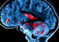 Case report: fatal dual meningitis with hydrocephalus in HIV-negative woman