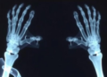 Cancer survivors miss early bone-density testing in Israeli real-world study