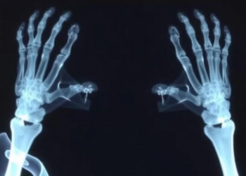 Cancer survivors miss early bone-density testing in Israeli real-world study