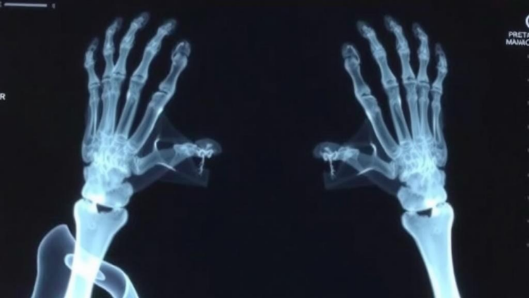 Cancer survivors miss early bone-density testing in Israeli real-world study
