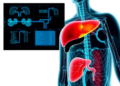 Model supports liver cancer screening at lower risk in alcohol-associated cirrhosis