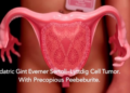 Case Report: Pediatric Giant Ovarian Sertoli–Leydig Cell Tumor With Precocious Puberty