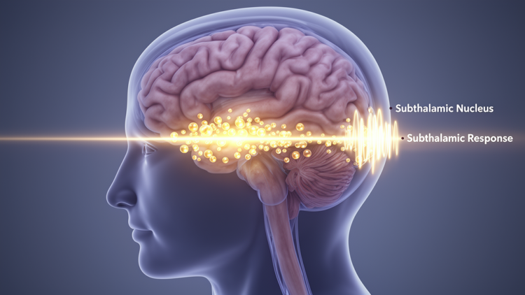 Dopamine amplifies delayed subthalamic responses in Parkinson’s patients