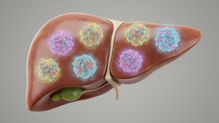 AI could clarify molecular diversity in ovarian cancer liver metastases
