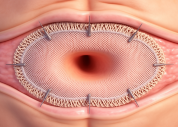 Mesh–Defect Matching May Matter More Than Fixation in Hernia Repair