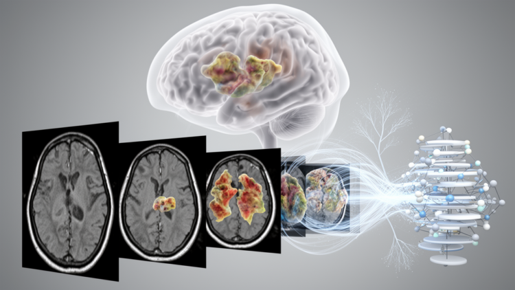 UAC-Net links brain-tumor typing and MRI segmentation in one model