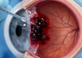 Tenecteplase-assisted surgery displaces PCV hemorrhage in 10-eye series