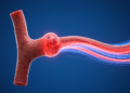 Physics-informed AI reduces errors in aneurysm flow reconstructions
