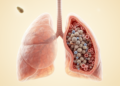 PCP, not bacterial co-infection, linked to pulmonary cryptococcosis mortality
