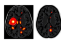 AI Reads Tumor Habitats on MRI to Predict Prostate Cancer Aggressiveness Before Surgery