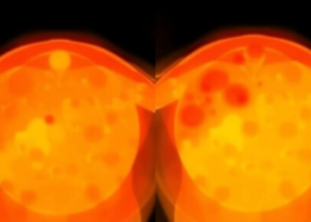 PSMA PET reveals uneven prostate-bed recurrence after prostatectomy