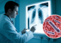 Sulfur granule-negative pulmonary Schaalia odontolytica infection that mimics lung cancer with lack of radiological response to β-lactam therapy: a case report