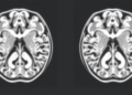 Tracer Debate: Fluorinated MIBG Alternative Sparks Scientific Exchange in Neuroblastoma Imaging