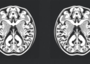 Tracer Debate: Fluorinated MIBG Alternative Sparks Scientific Exchange in Neuroblastoma Imaging
