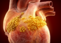 Retrospective 10-year Beijing cohort links S. aureus to severe pediatric infective endocarditis