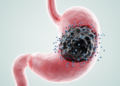 Early tumor shrinkage associated with longer progression-free survival in measurable advanced gastric or gastroesophageal junction cancer