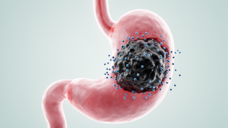 Early tumor shrinkage associated with longer progression-free survival in measurable advanced gastric or gastroesophageal junction cancer