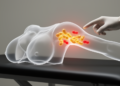 Review links intramammary lymph node metastasis with axillary involvement in primary breast cancer
