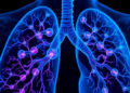 Hidden Fibroblast Subtype Drives Lung Cancer Growth and Weakens Immunotherapy
