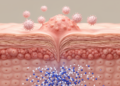 Review maps molecular pathways and management strategies for low-risk HPV skin warts