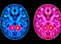 AI Reads Brain Scans Two Ways at Once to Gauge Neurological Disease Severity