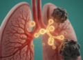 Post-treatment serum IL-6 independently associated with progression in observational cohort of advanced NSCLC with COPD