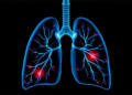 AI Plans Safer Needle Paths for Lung Biopsies, Feasibility Study Finds