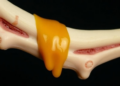 Rare Dripping Candle Wax Bone Disease Diagnosed Without a Single Biopsy