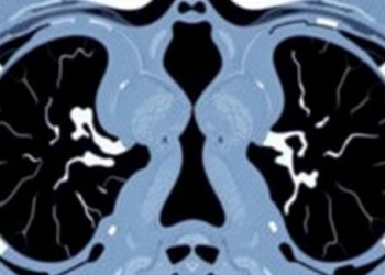 Four in Ten COVID-19 Chest CT Scans Were Medically Unnecessary, Iranian Study Finds