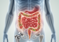 Gut bacterial patterns linked to delirium after hip fracture surgery