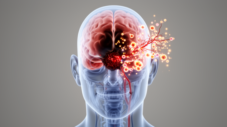 Anxiety changes how inflammation marker relates to acute stroke severity