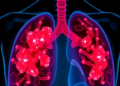 Lung Cancer Cavities Enlarged as Solid Components Regressed in Case Report