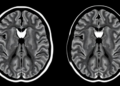 High-Resolution MRI Shows Stroke Risk Follows Different Rules in Moyamoya Disease and Its Atherosclerotic Mimic