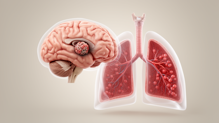 Case report links GPA mimic to lung cancer brain metastasis