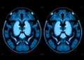 AI Reads Ultrasound to Sort Parotid Tumors With Striking Accuracy