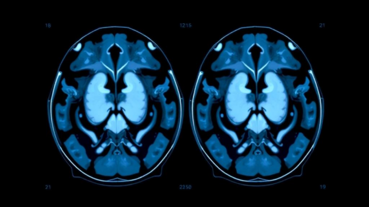AI Reads Ultrasound to Sort Parotid Tumors With Striking Accuracy