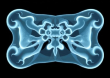 AI Models Predict Bone Scan Outcomes Before Imaging, but Time May Erode Their Accuracy