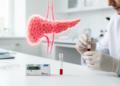 Low lipoprotein(a) and high TyG index mark diabetes risk in prediabetes
