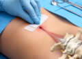 Puncture-site closure linked to early wound events after vertebroplasty