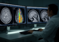 Spectral CT plaque measure linked to cerebral small vessel disease burden