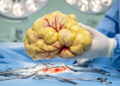 Giant Hypervascular Liposarcoma Removed From Cervicodorsal Region