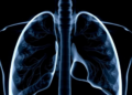 Clinical predictors of tracheobronchial tuberculosis and airway stenosis in pulmonary tuberculosis