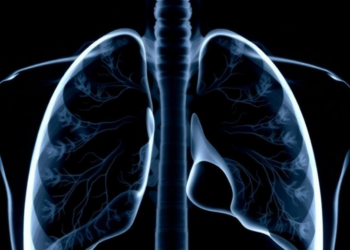 Clinical predictors of tracheobronchial tuberculosis and airway stenosis in pulmonary tuberculosis