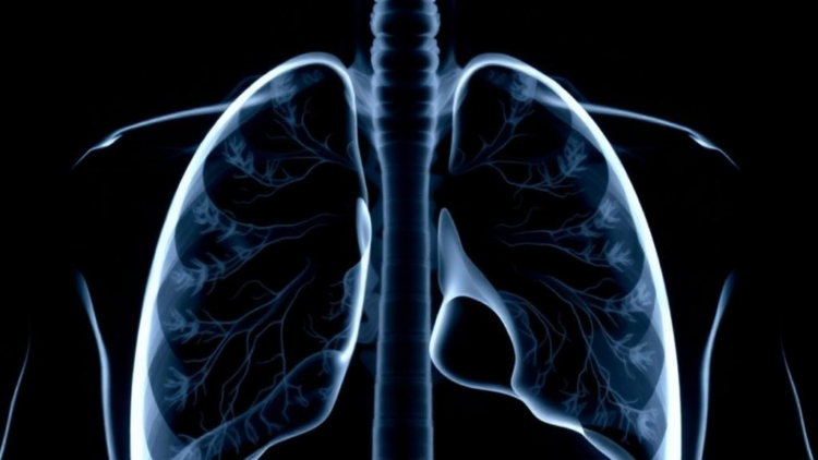 Clinical predictors of tracheobronchial tuberculosis and airway stenosis in pulmonary tuberculosis