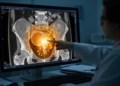Case Report Documents Bladder Rupture With OHVIRA Syndrome