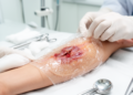 Small case series links hydrogel template to healing in 13 complex wounds