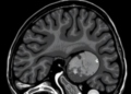 Small-cohort nnU-Net study shows promise for pediatric Wilms tumor MRI segmentation
