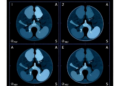 AI Reads Breast Microcalcifications With New Precision, Cutting Unneeded Biopsies