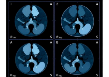 AI Reads Breast Microcalcifications With New Precision, Cutting Unneeded Biopsies
